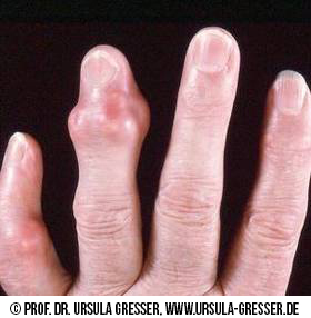Die Darstellung zeigt Finger-Tophi. gefunden auf: https://www.was-ist-gicht.de/symptome.html